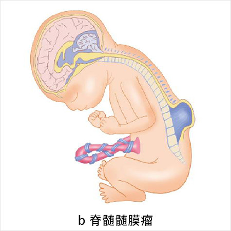 図：脊髄髄膜瘤をもった胎児
