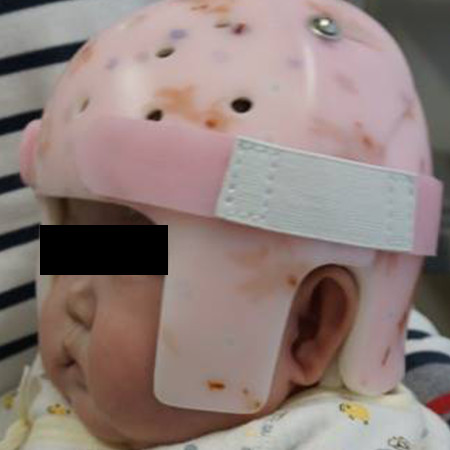 写真：ヘルメットをつけた乳児